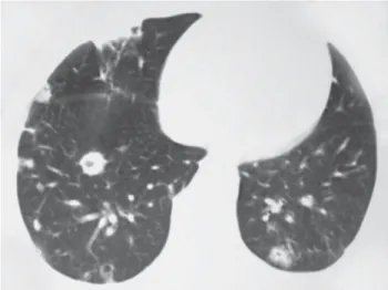 Figura 1. TC com janela para o pulmão, ao nível das bases pulmonares, mostrando múltiplos nódulos de tamanhos variados,  muitos deles escavados, com distribuição predominantemente periférica.