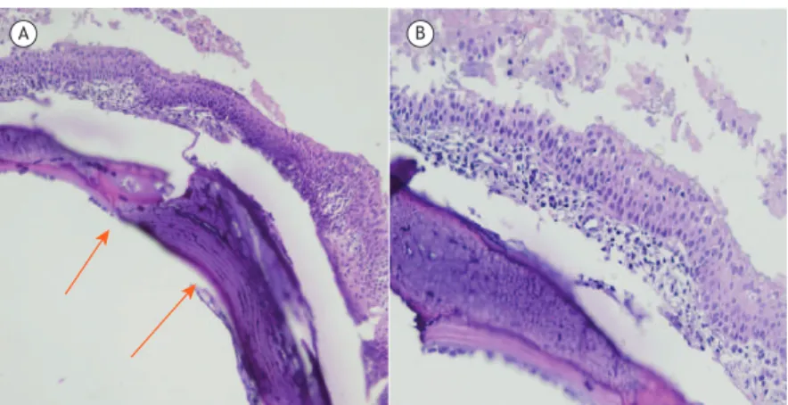 Figura 3.  Em  A,  tecido  cartilaginoso  anormal  em  região  de  submucosa  com  ossiicação  metaplásica  (setas;  H&amp;E; 