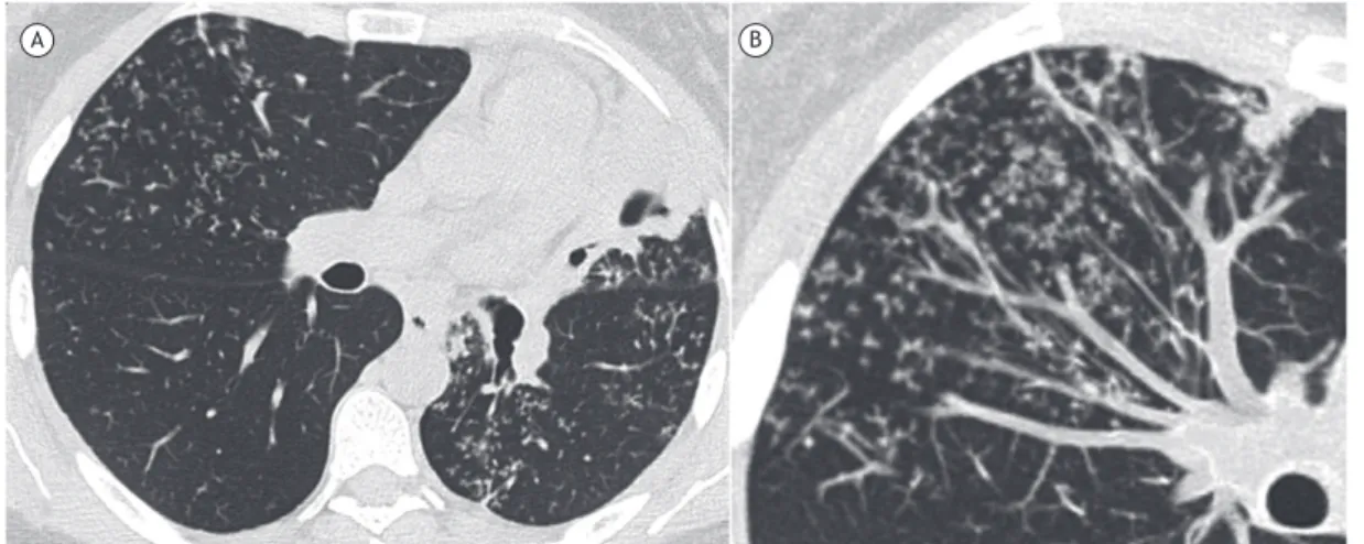 Figura 1. Em A, TC do tórax em corte axial com janela para pulmão, no nível da região subcarinal, mostrando redução  volumétrica do pulmão esquerdo, com consolidação escavada na língula