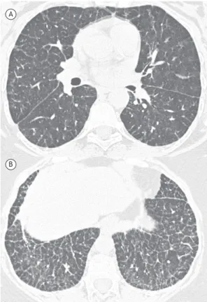 Figure 1.  Twenty-eight-year-old  female  patient.  Chest  HRCT  slices  (lung  window)  from  the  lower  lung  zones