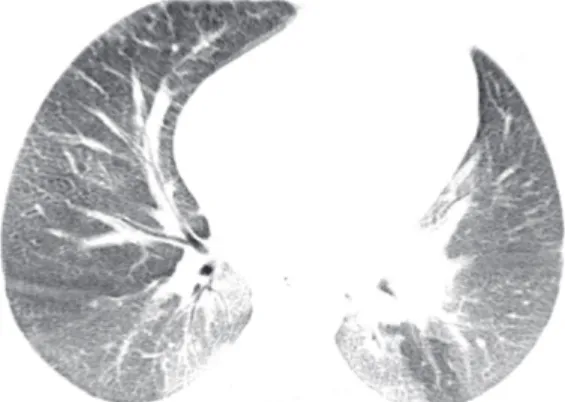 Figure 2. Sixteen-year-old male patient. Chest HRCT slices  (lung window) from the lower lung zones