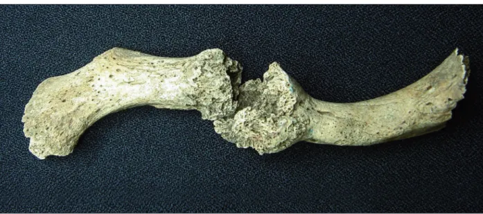 figura 5. fratura em clavícula esquerda apresentando pseudoartrose – sambaqui da Beirada (rJ)