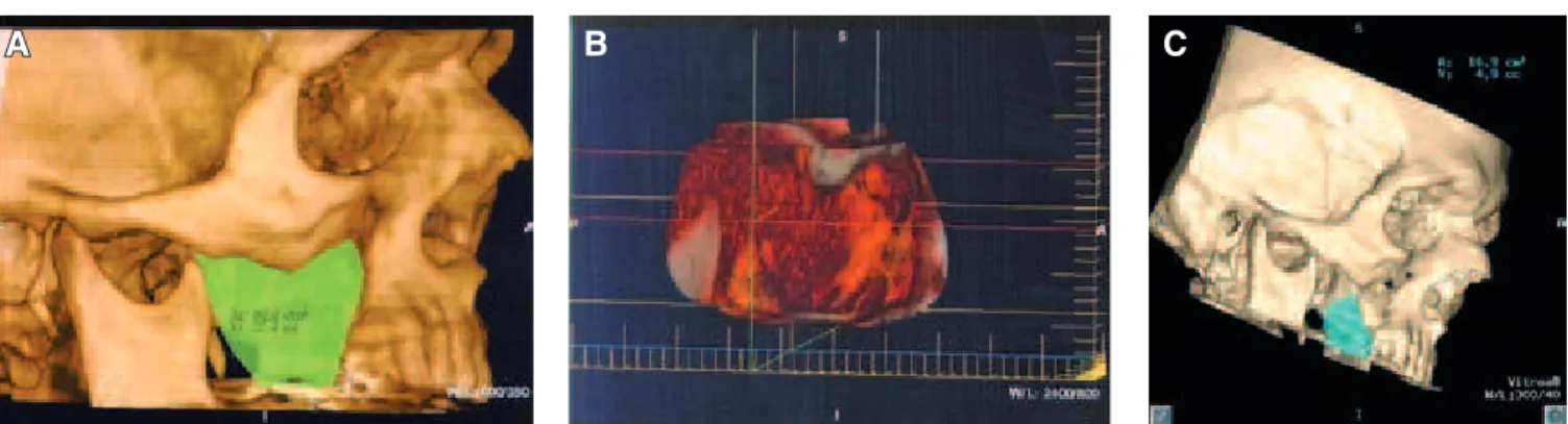 FIGURE 3 - A  and  B:  Axial views at soft tissue window level showing fibrosarcoma on the left side involving the maxil- maxil-lary sinus, pterigoid process, lateral pterigoid muscles, nasal fossa, maxilla, and zygomatic bone (arrows);  C:  3D-CT  frontal
