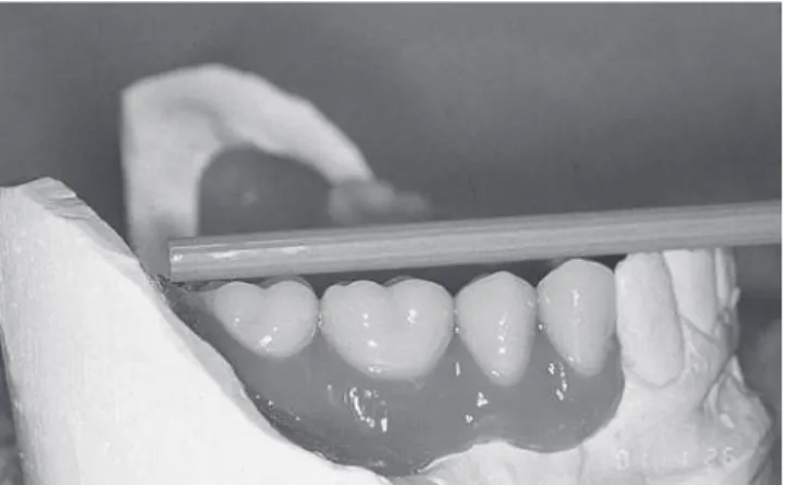 Figure 1. Base points were created by setting 3 mm  ball-bearings at the end of the 2 nd  third of the  ret-romolar pad, fixed in the internal part of the resin  base