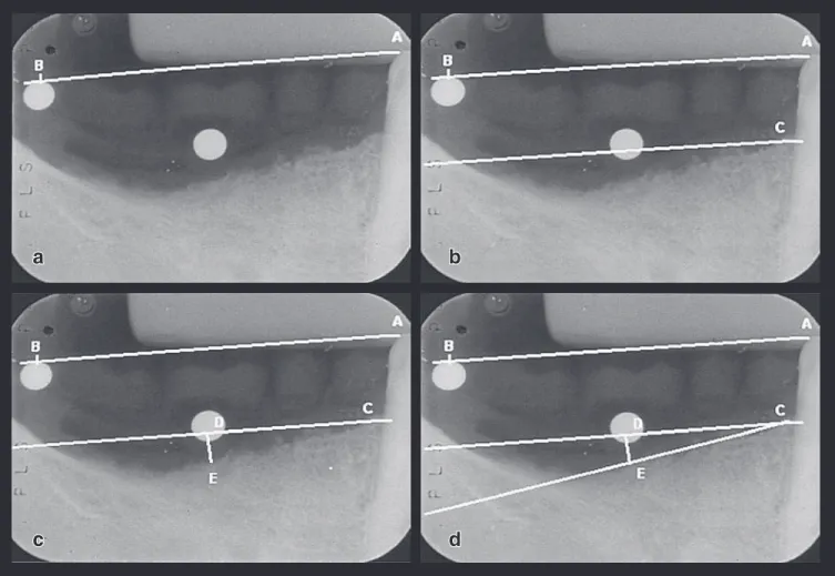 FIGURE 2 - a) radiographic image with tracing representing the occlusal plane (line segment AB); b) line segment  parallel to the occlusal plane taking the distal alveolar crest of the abutment tooth (point C) as the point of reference; 