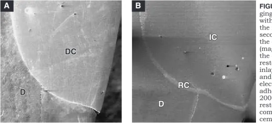 FIGURE 2 -  A : SEM of the dentin  gingival margin cavity restored  with direct composite showing  the marginal gap and large  secondary electron image along  the dentin/adhesive interface  (magniication 200 X)