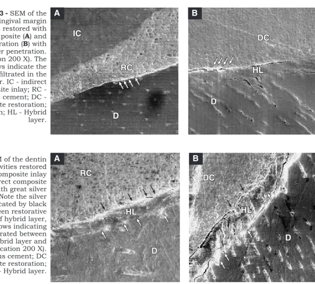 FIGURE 4 - SEM of the dentin  gingival margin cavities restored  with indirect composite inlay  ( A ) and direct composite  restoration ( B ) with great silver  penetration