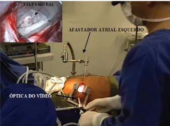 Fig. 2 - Aspecto do campo operatório, demonstrando afastador atrial esquerdo, minitoracotomia e local da ótica de vídeo