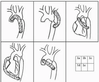 Fig. 1 - Desenho esquemático das várias abordagens para tratamento de coarctação de aorta através de desvios  extra-anatômicos