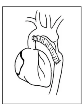 Fig. 2 - Desenho esquemático da operação realizada (abordagem toracotomia esquerda)