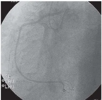 Fig. 1 - Cineangiocoronariografia da CD