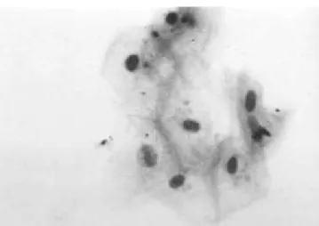 FIGURE 2 - Ground-glass nuclei: eosinophilic or baso- baso-philic inclusions that cause homogenization of the  nu-clear  surface  and  peripheral  margination  of  the   chro-matin