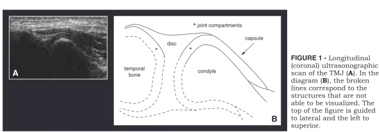 FIGURE 1 - Longitudinal  (coronal) ultrasonographic  scan of the TMJ ( A ). In the  diagram ( B ), the broken  lines correspond to the  structures that are not  able to be visualized