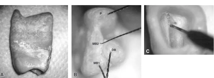 FIGURE 1A THROUGH C - One of the irst maxillary molars used in this experiment (A). By inspecting the roots fo- fo-ramina, we can see the presence of four canals (B)