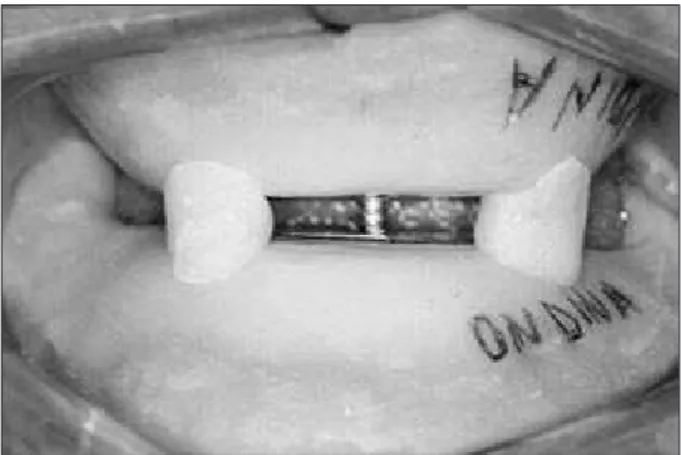 Figure 1 - Baseplates fixed to each other with the set in the  centric occlusion point.