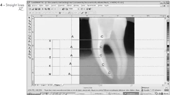 Figure 5 - Initial canal  thickness – BC.