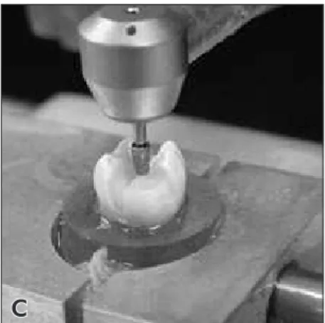 Figure 3 - Confection of an onlay  preparation with mesio-buccal   cusp coverage. (A) definition of a  2.5 mm-wide and 2.5 mm-deep  occlusal isthmus