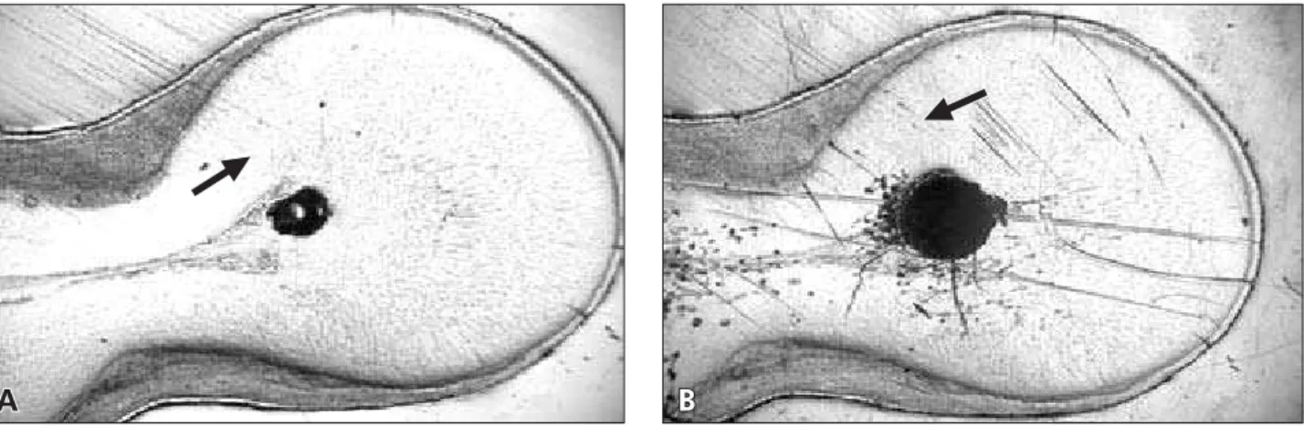 Figure 3 - (A) Initial cross-section area of the mesio-buccal canal of sample 7. (B): After Gates-Glidden preparation in crown- crown-down sequence, a limited increase of the cross-section area (79.2%) and a moderate reduction in the smallest distance to t