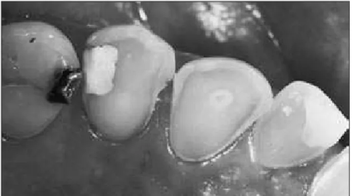 Figure 2 - Male patient, 57 years old, showing advanced  erosive tooth wear. Note the intact enamel border along the  gingival margin of all teeth and some biofilm remnants;  se-vere occlusal and palatal erosive tooth wear with worn cusps  in the premolars