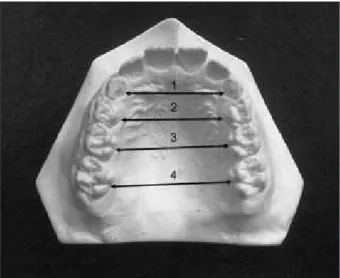 Figure 3 - Schematic drawings of measurements performed  in the orthodontic study models.