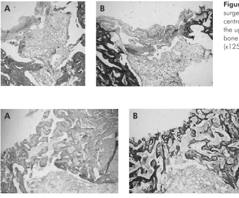 Figure 2 - PRGF treated defect, two  months after surgery. (A) Larger-size  bone trabeculae (x200,  hematoxylin-eosin)