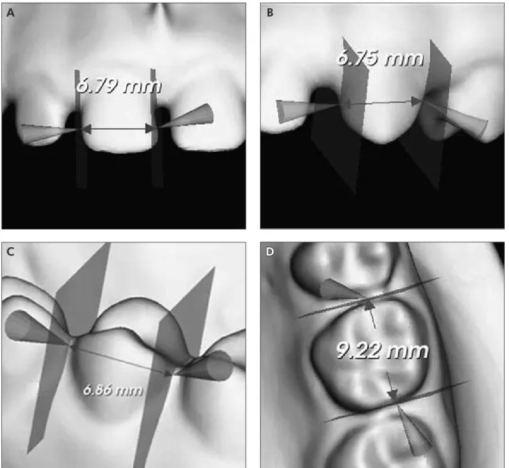 Figure 1 - Measurements of mesiodistal width of (A) incisor, (B) canine, (C) premolar and (D) molar using the Cécile3 tool,  as shown from different views.