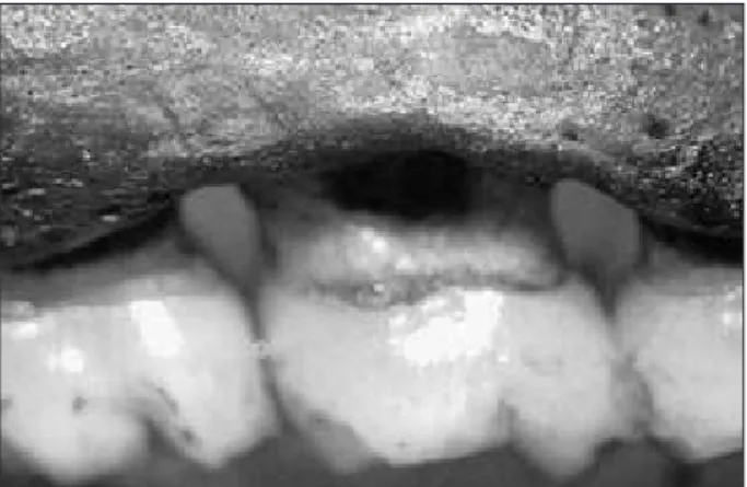 Figure  5  -  Photograph  illustrating  the  morphometrically  observed  bone  loss  in  the  control  group,  buccal  site  of  a  ligated tooth.
