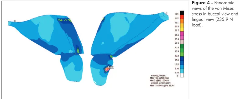 Figure 4 - Panoramic  views of the von Mises  stress in buccal view and  lingual view (235.9 N  load).