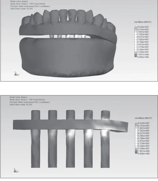 Figure 5 - Occlusal load applied on  the first and second premolars.