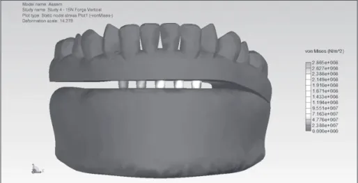 Figure 7 - Occlusal load applied on  the first and second premolars and on  the first molar.