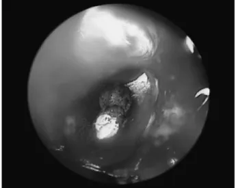 Figure  1 - Endoscopic view of the surface of the resected  root end.