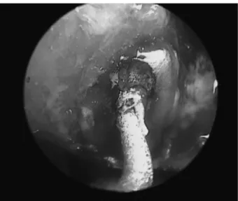 Figure 2  - Endoscopic view of the retro-tip positioned in the orifice of the root canal system.
