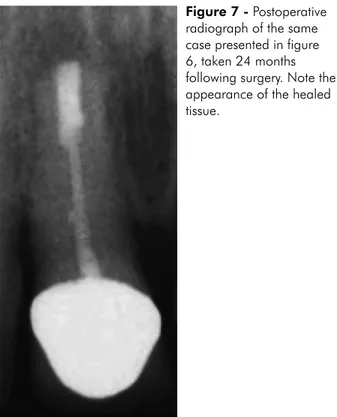 Figure 6 - Radiograph  obtained during a  preliminary visit showing  a periapical lesion in  a maxillary left central  incisor.