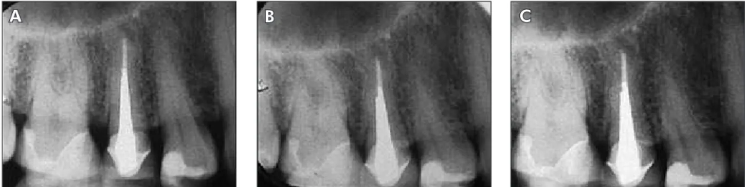 Figure 1 - Analysis of conventional radiographs using different techniques: (A) Parallelism; (B) Mesially 20°; (C) Mesially 25°