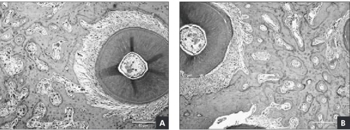 Figure 3 - Alveolar bone in the alendronate-treated (A) and control (B) group. The bone tissue characteristics were similar in  both groups with respect to the distribution and number of reversion lines, and proportion of medullar spaces, bone trabeculae  