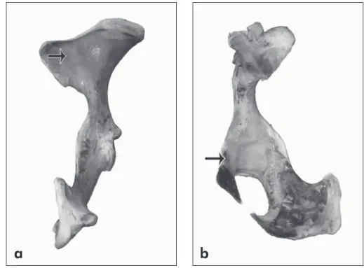 Figure 1 - Macroscopic view of  the right hemi pelvis. (a) caudal  view: the arrow indicates the gluteal  wing of the iliac bone