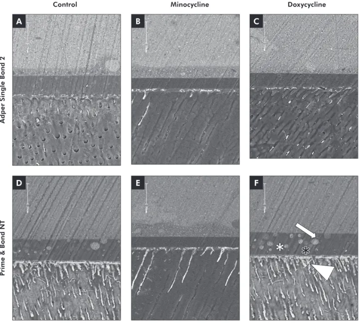 Figure 1 - Backscattered SEM images of the resin-dentin interfaces bonded with SB (A to C) and PB (D to F)