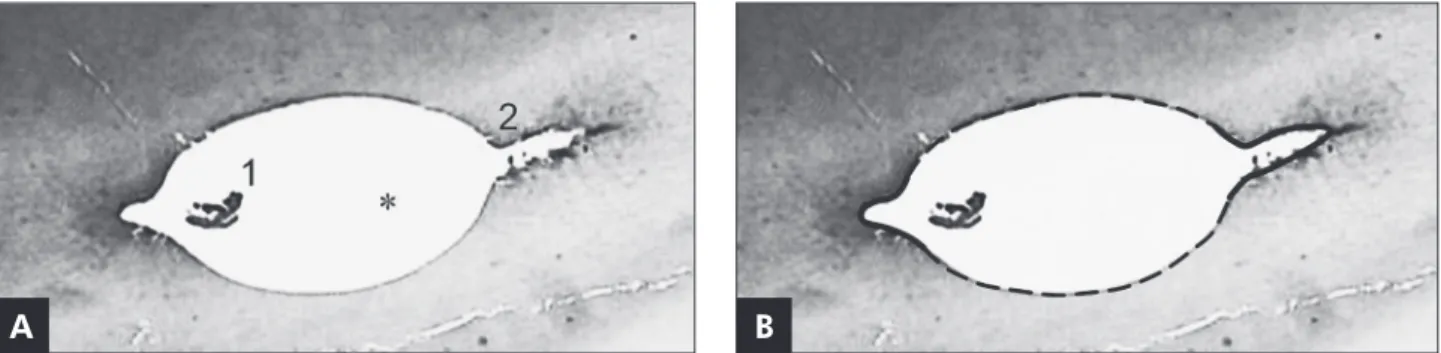 Table 1 - Percentage of the area  of the transversal section of the  root canal containing debris, and  percentage values of the perimeter  of the areas unaffected by the  instruments.