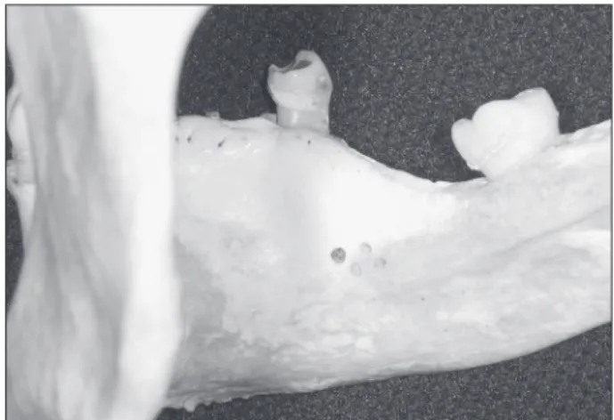 Figure  1  -  Simulated  bone  lesions  on  the  lingual  cortical  bone of the mandibular body.