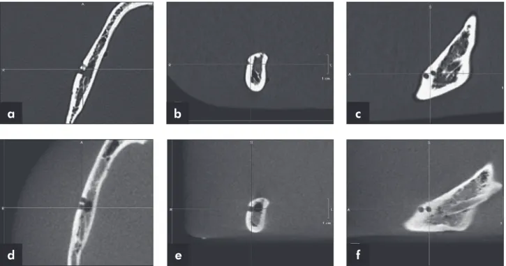 Figure 2 - MSCT (a, b, c) and CBCT (d, e, f) axial/MPR images.