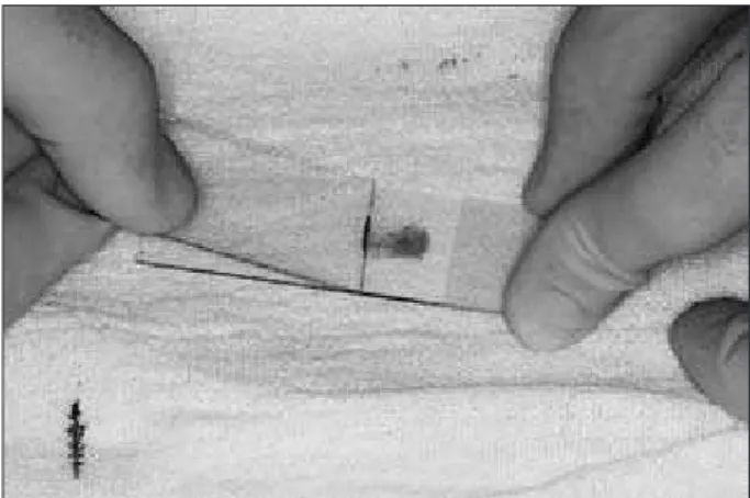 Figure 2 - Introducing the needle inside the lesion to do the  back and forth movement.