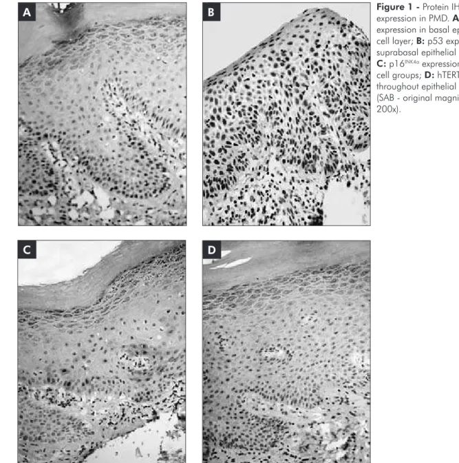 Figure 1 - Protein IHC  expression in PMD. A: p53  expression in basal epithelial  cell layer; B: p53 expression in  suprabasal epithelial cell layers; 