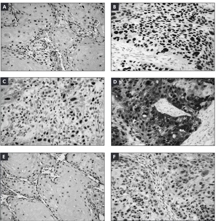 Figure 2 - Protein IHC expression in OSCC. A and B: p53 in WD and PD cases; C: p16 INK4a  focal expression in a WD case; 