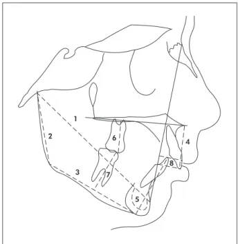 Figure 1 - Cephalometric landmarks, reference lines, and  linear measurements used in the study