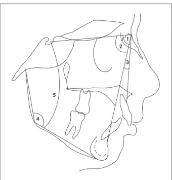 Table  2  displays  the  descriptive  analysis  and  comparison of the cephalometric measurements  ac-cording to treatment with or without the extraction  of four premolars