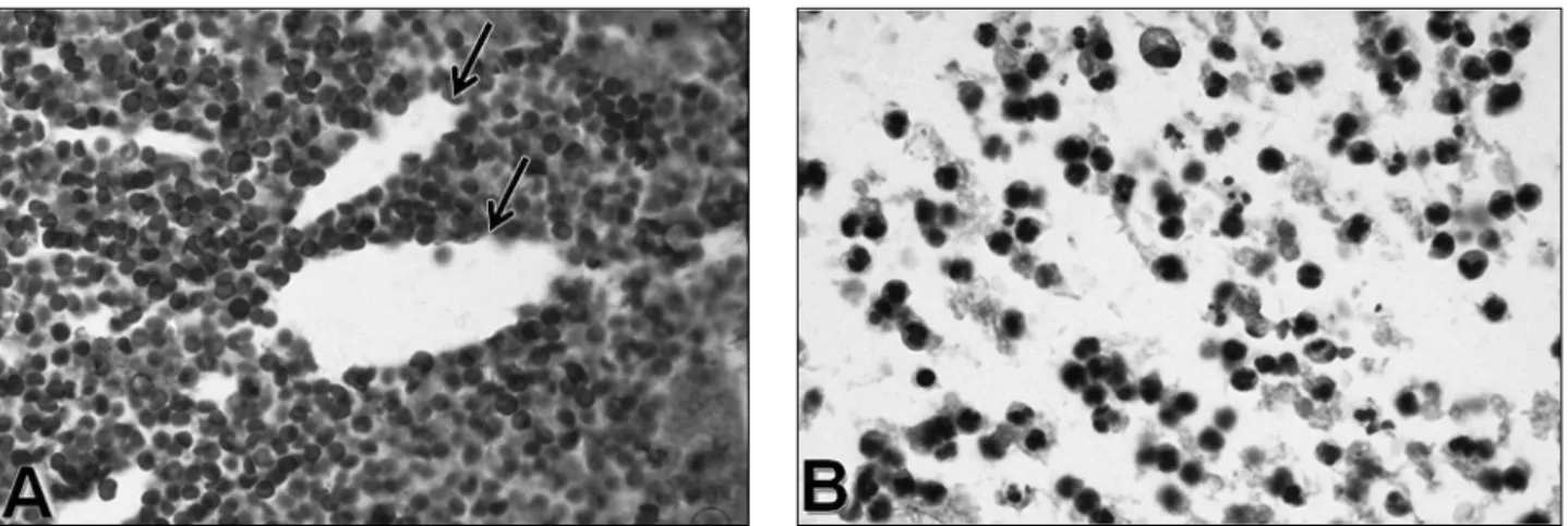 Figure 2 - Cytological analysis (cell block) of cysts. (A) Cholesterol crystal clefts (arrows), a few inflammatory cells, and a large  number of erythrocytes in a residual cyst (H&amp;E 400×)