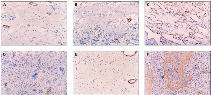 Figure 1 - Immunohistochemical reactivity for alpha smooth muscle actin ( α -sma) (original magnification 200 × ):  (A) focal  fibrous hyperplasia (FFH); (B) peripheral ossifying fibroma (POF); (C) pyogenic granuloma (PG); (D) peripheral giant cell  granu-