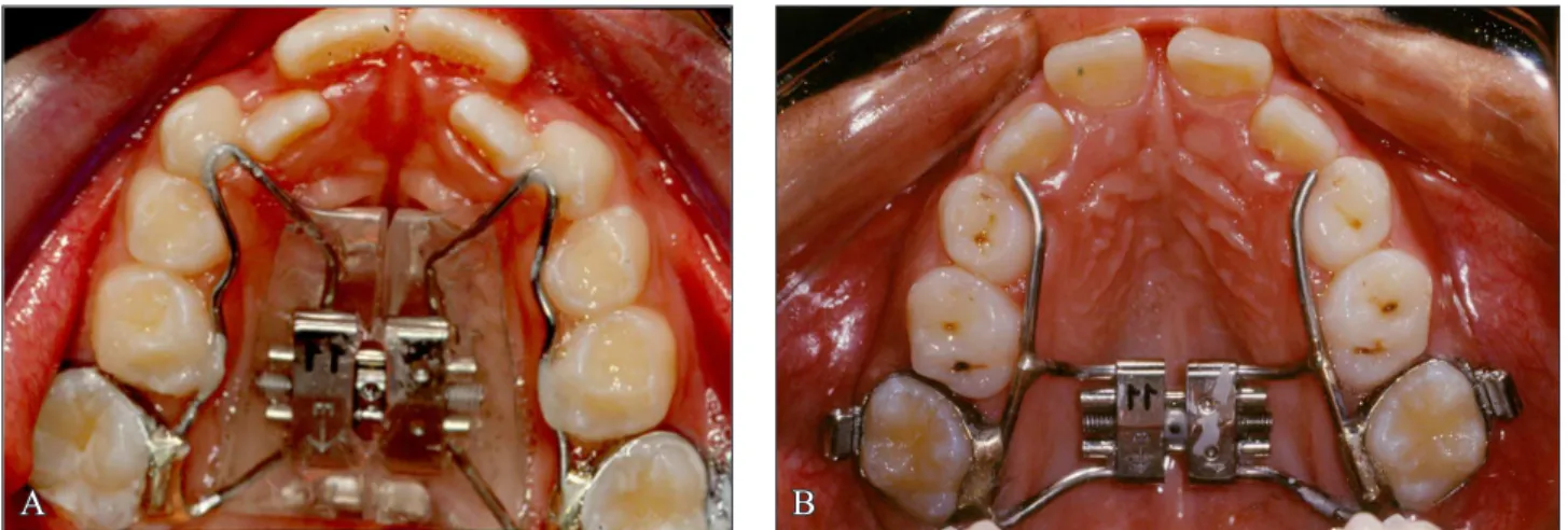 Figure 1 - Tooth-tissue-borne (A) and tooth-borne expanders (B).