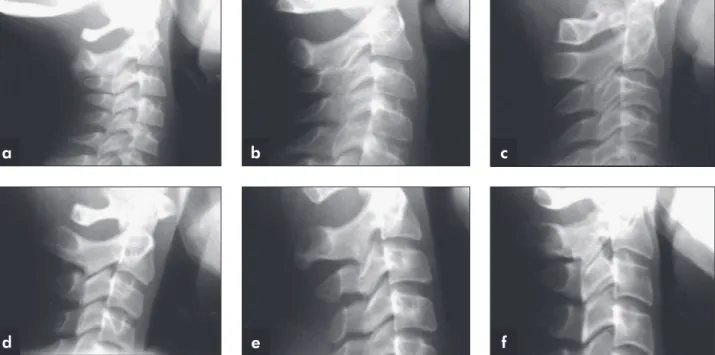 Figure 1 - Vertebral bodies with respective descriptions of each maturation stage of cervical vertebrae according to the Hassel and  Farman 8  classification (1995)