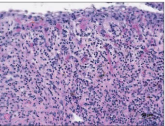 Table 1 - Intensity of inflammatory  infiltrate according to thickness of  epithelial lining in periapical cysts.